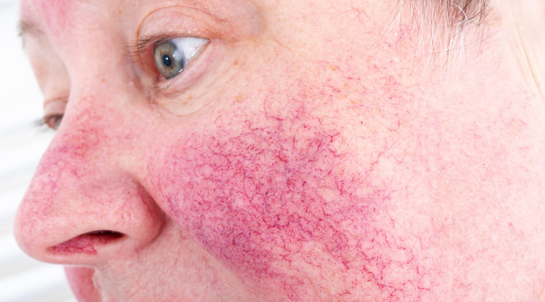 Rosacea is Not a Life Sentence