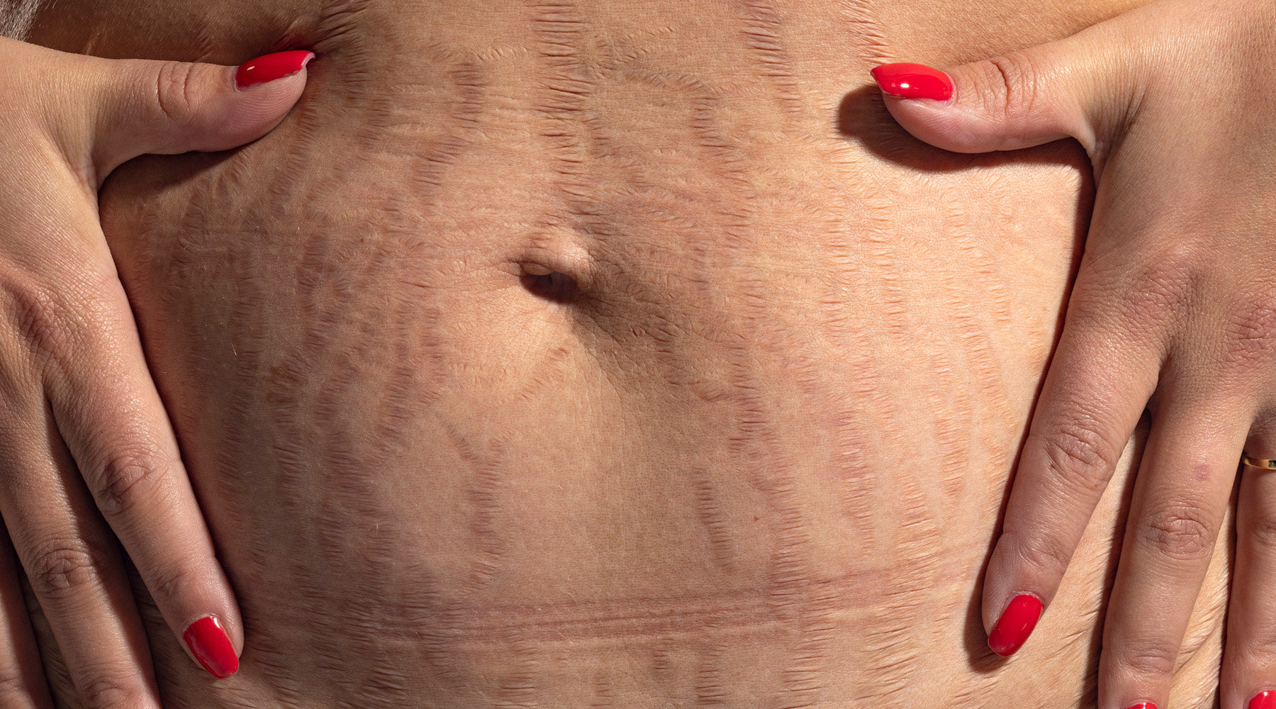 Fade the Marks: How to Diminish Stretch Marks and Regenerate Your Skin