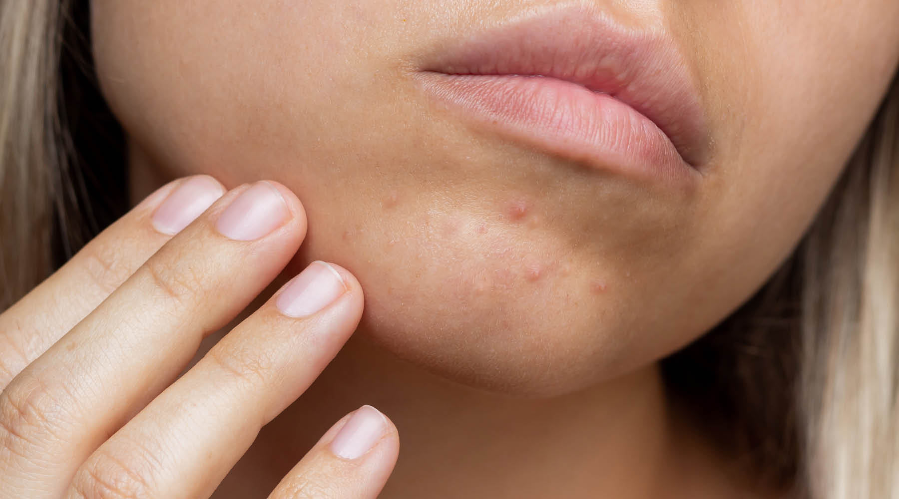 Postpartum Acne: Why You're Getting Hormonal Acne After Having a Baby (And What Can Help)
