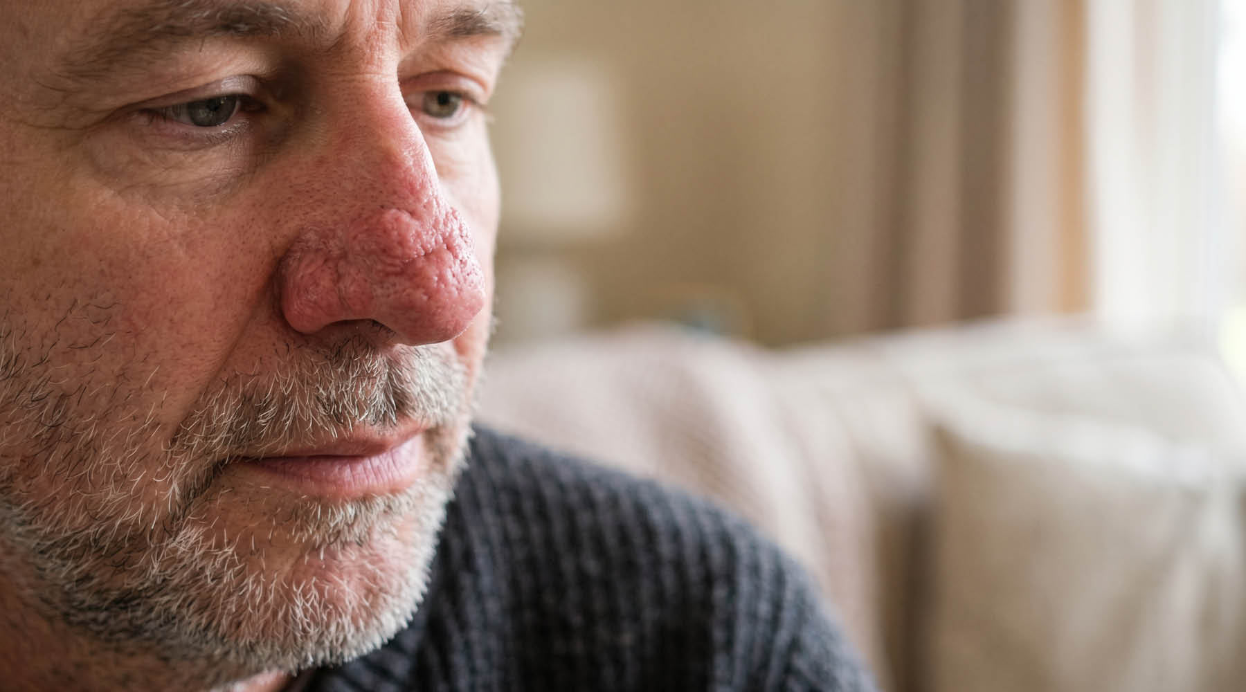 Rhinophyma: When Rosacea Changes the Structure of the Skin