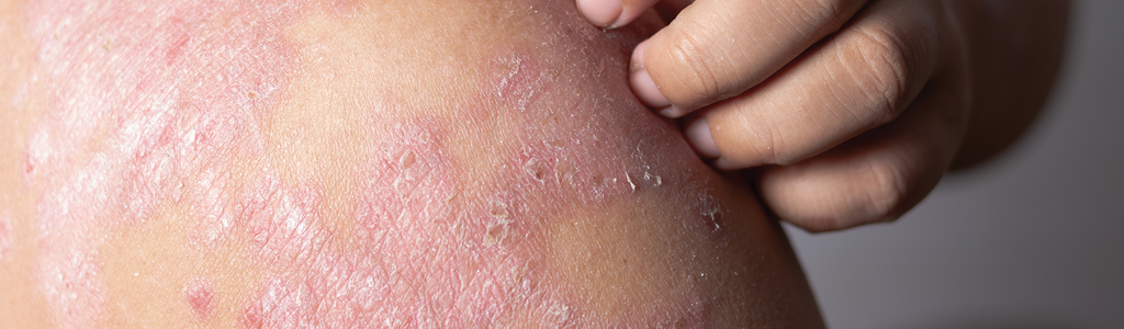 What is Psoriasis — how to differentiate Eczema and Psoriasis