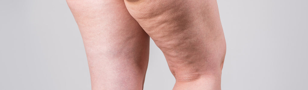 What is the Role of Brown Fat in Cellulite Formation