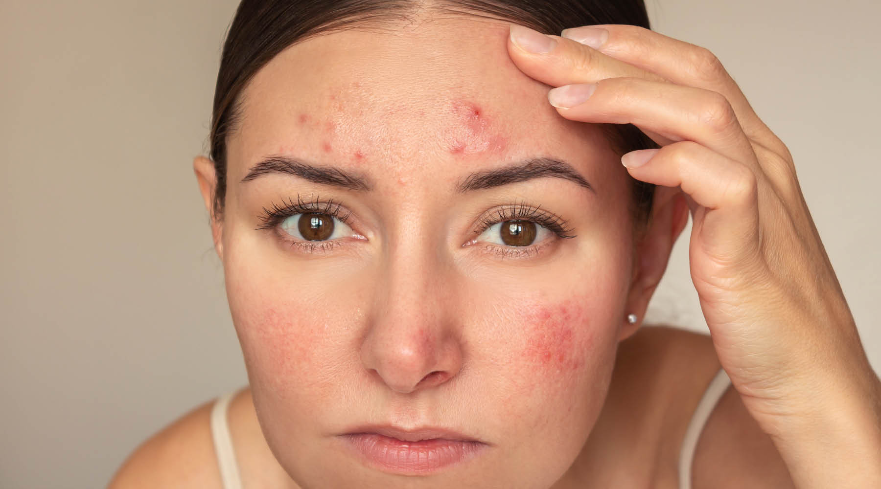 Lifestyle Factors That Trigger Acne