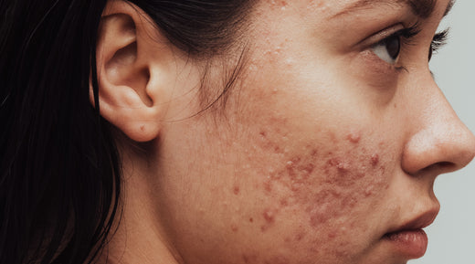 Why Most People Are Still Struggling with Acne