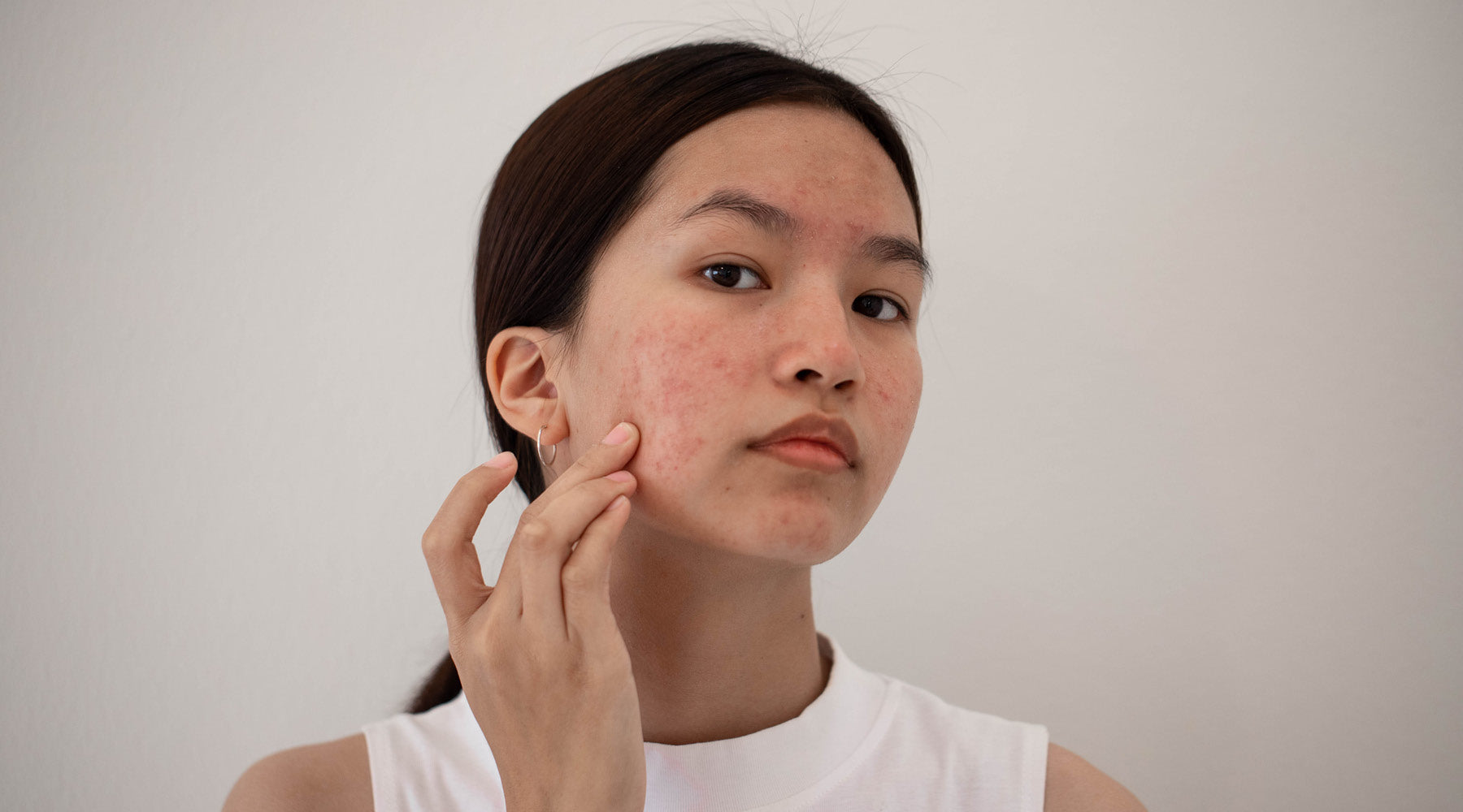 Hormonal Havoc: Taming Adult Hormonal Acne in Women Over 25
